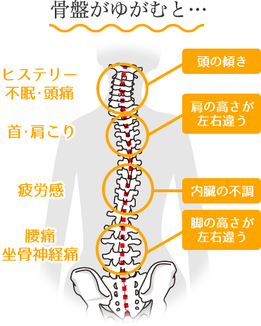 骨盤がゆがむと…ヒステリー/不眠･頭痛/不眠･頭痛/疲労感/腰痛/坐骨神経痛